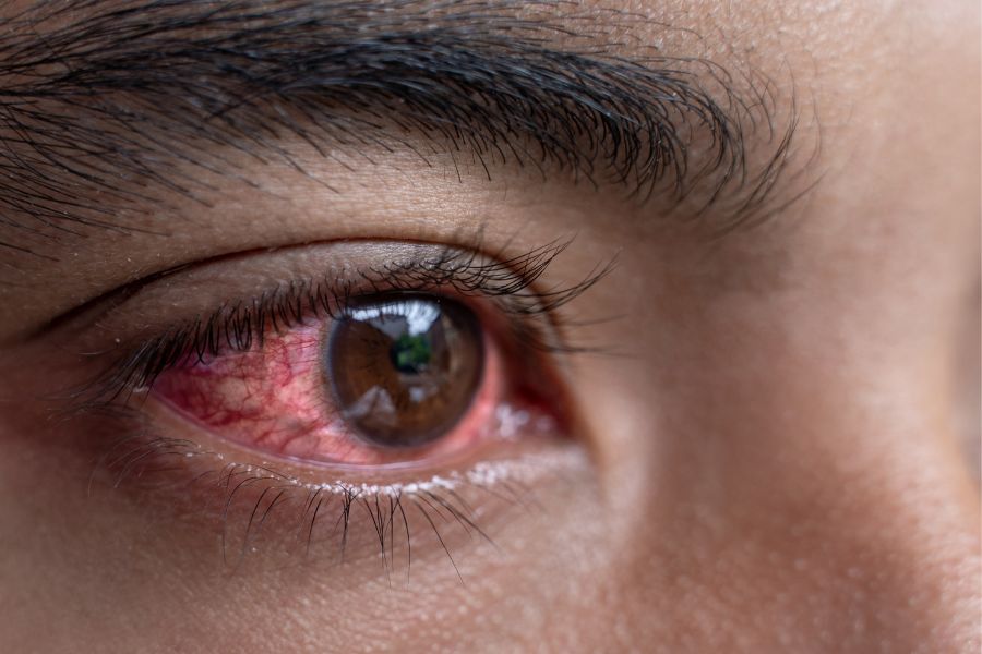 Man with red eyes